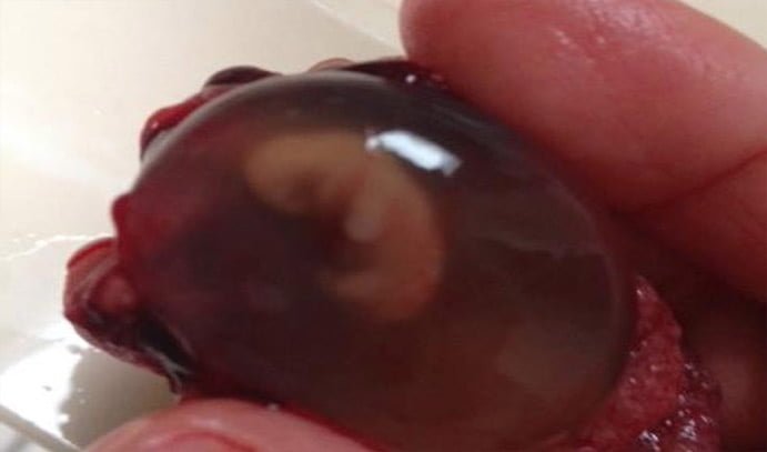 Embrión de siete semanas